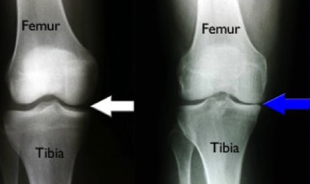 Standing knee x-rays show joint space narrowing in the setting of osteoarthritis.