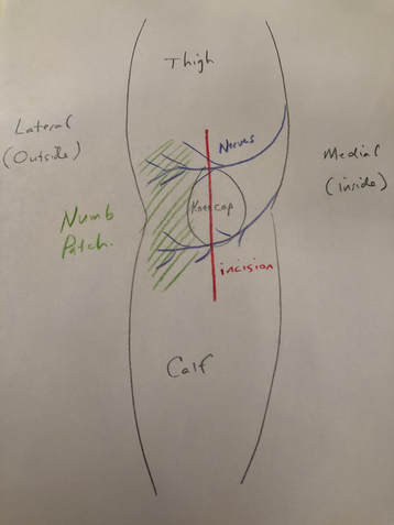 Sketch showing numb patch on the lateral aspect of the knee after knee replacement surgery